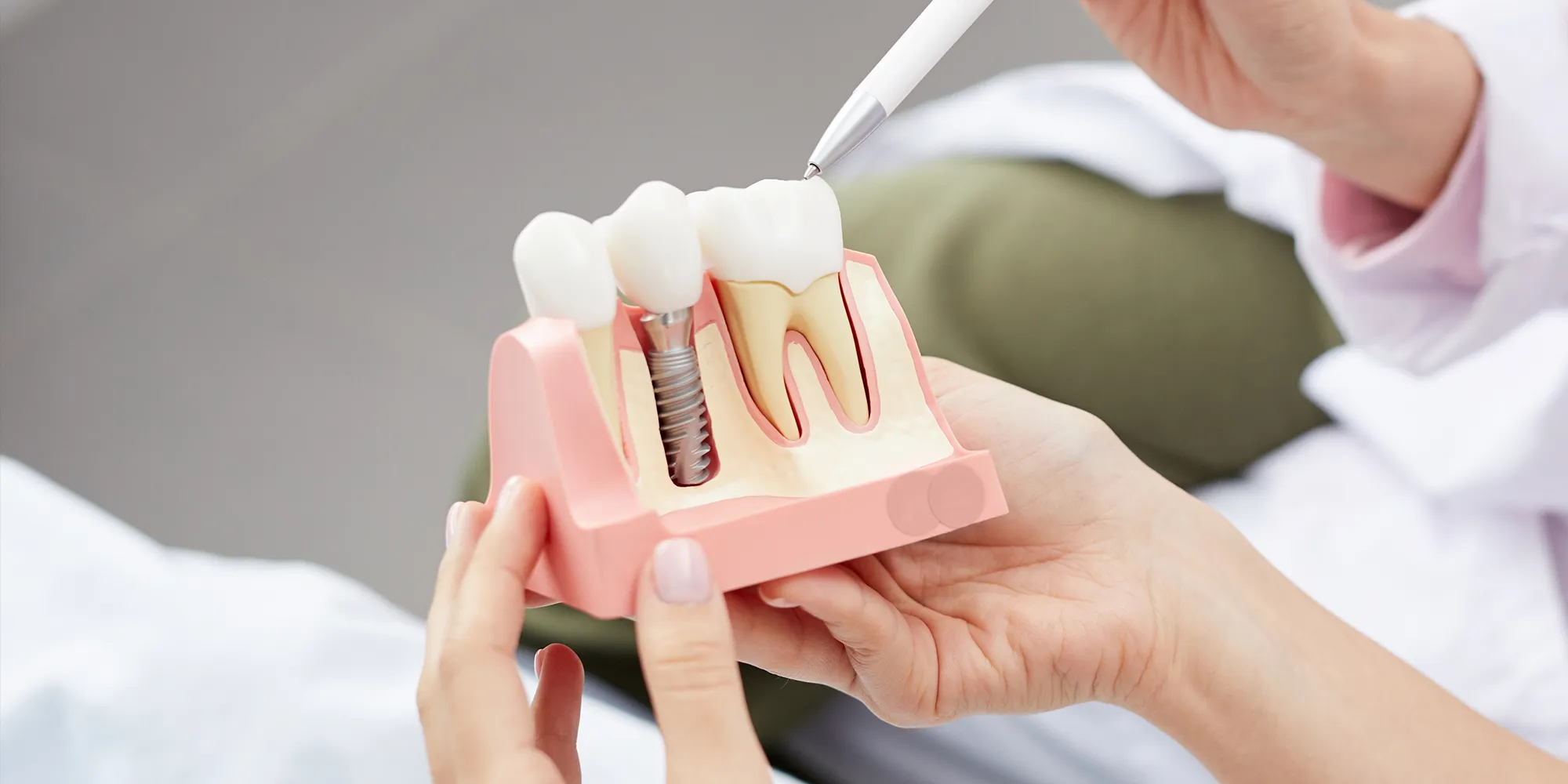 Dental Implants