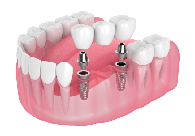 Dental Bridges