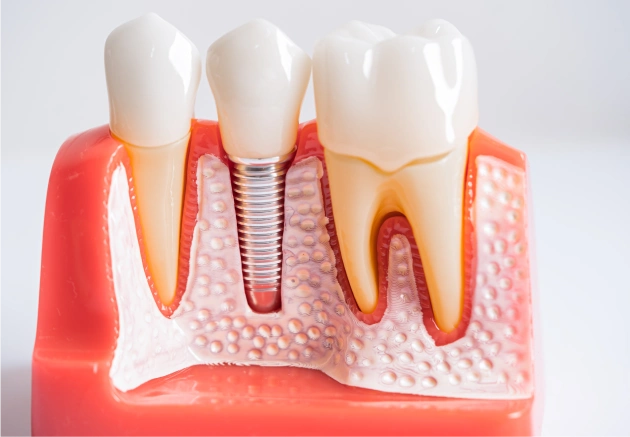 Dental Implant