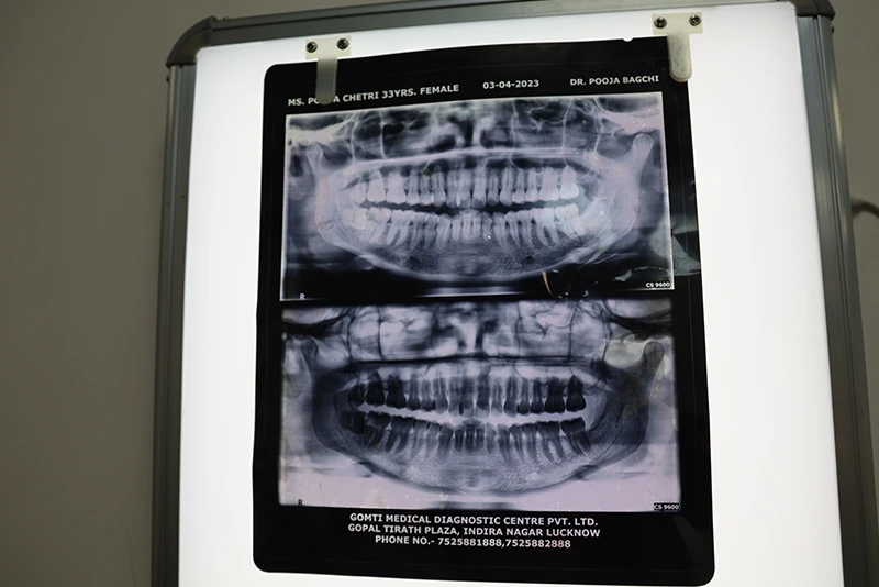 Tooth X-Ray