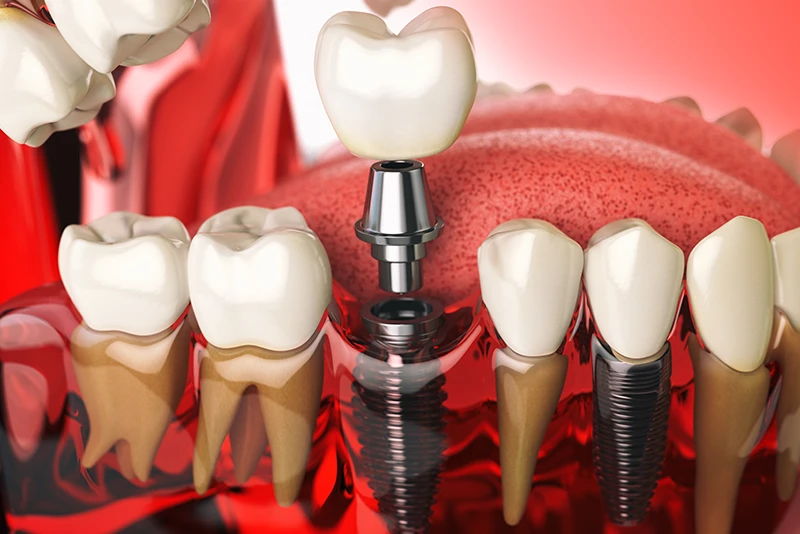 Tooth Implant