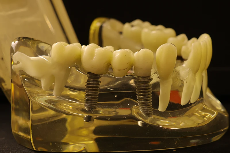 Dental Implant (4)